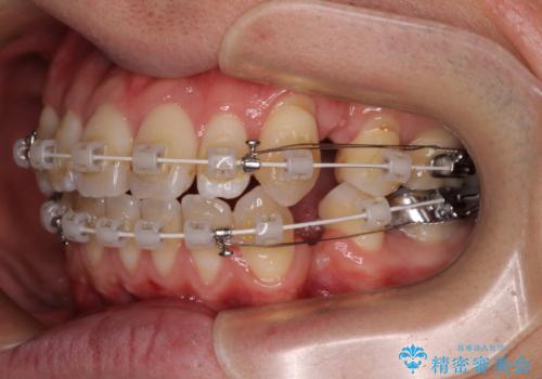口元の突出感を改善!目立ちにくいワイヤー矯正で自信を持てる自然な横顔にの治療中