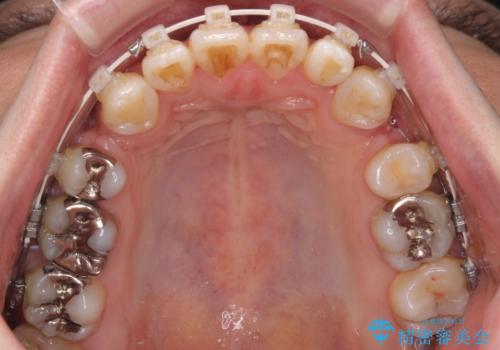 口元の突出感を改善!目立ちにくいワイヤー矯正で自信を持てる自然な横顔にの治療中