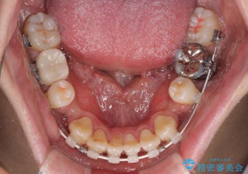 口元の突出感を改善!目立ちにくいワイヤー矯正で自信を持てる自然な横顔にの治療中