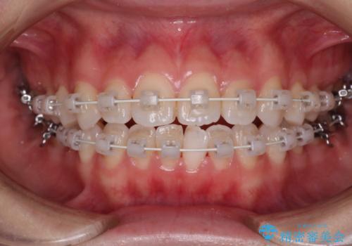 【審美装置】前歯で噛めない!抜歯しないで治したいの治療中