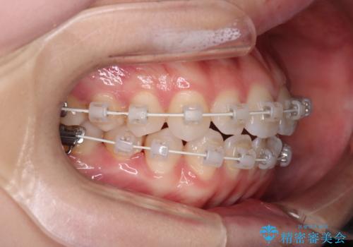 【審美装置】前歯で噛めない!抜歯しないで治したいの治療中