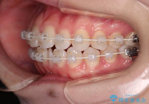 【審美装置】前歯で噛めない!抜歯しないで治したいの治療中