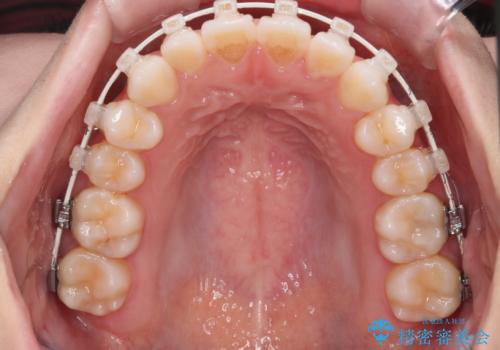 【審美装置】前歯で噛めない!抜歯しないで治したいの治療中