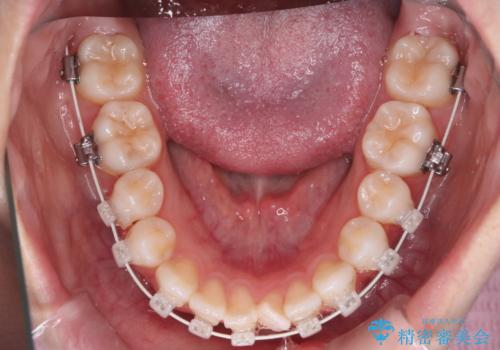 【審美装置】前歯で噛めない!抜歯しないで治したいの治療中