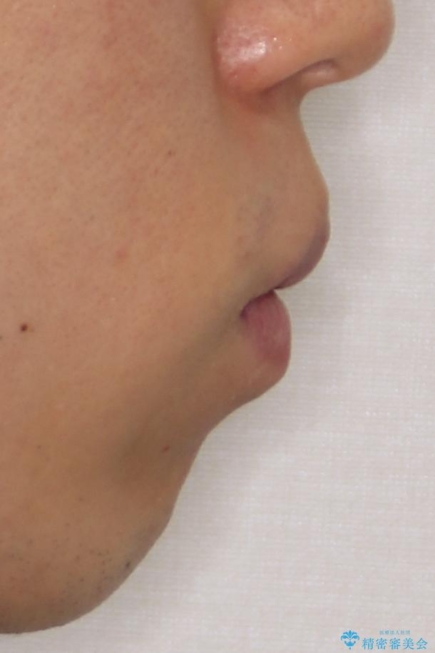 口元の突出感を改善!目立ちにくいワイヤー矯正で自信を持てる自然な横顔にの治療前(顔貌)