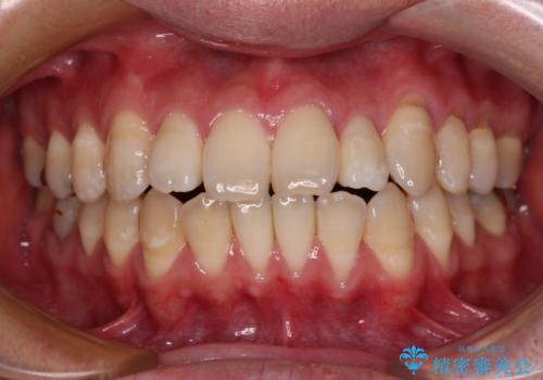 口元の突出感を改善!目立ちにくいワイヤー矯正で自信を持てる自然な横顔にの症例 治療前