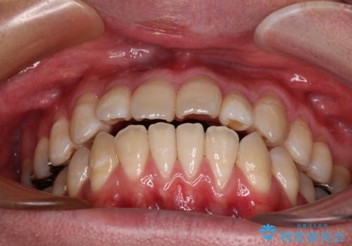 口元の突出感を改善!目立ちにくいワイヤー矯正で自信を持てる自然な横顔にの治療前