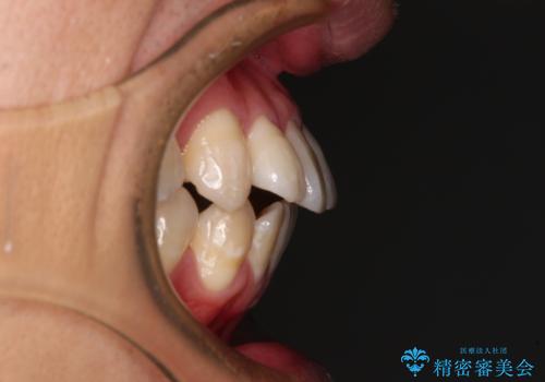 口元の突出感を改善!目立ちにくいワイヤー矯正で自信を持てる自然な横顔にの治療前