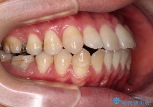 口元の突出感を改善!目立ちにくいワイヤー矯正で自信を持てる自然な横顔にの治療前