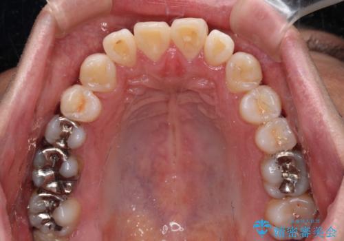 口元の突出感を改善!目立ちにくいワイヤー矯正で自信を持てる自然な横顔にの治療前