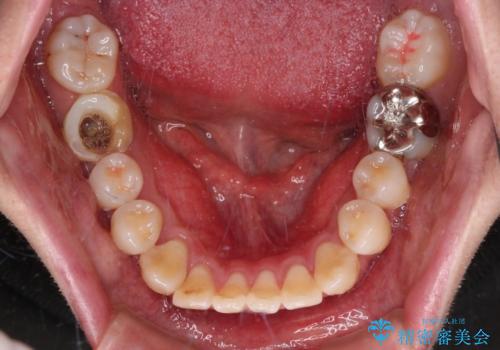 口元の突出感を改善!目立ちにくいワイヤー矯正で自信を持てる自然な横顔にの治療前