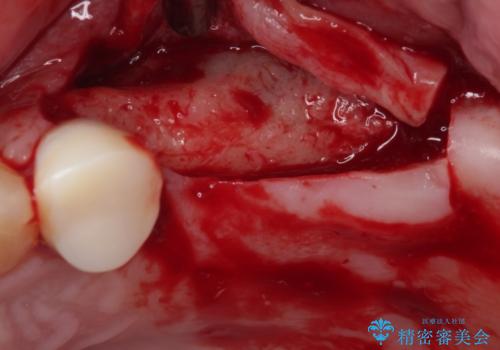 欠損の多い奥歯 インプラントによる補綴治療の治療中