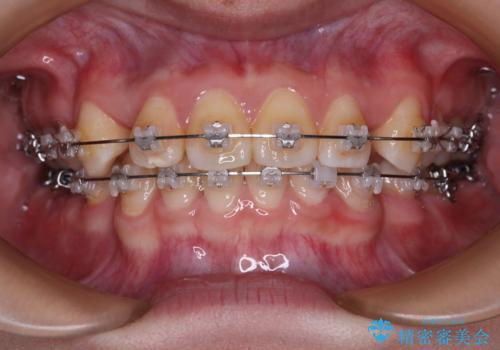 転勤でも安心して治療継続 抜歯スペース閉鎖と深い噛み合わせ改善のワイヤー矯正の症例 治療前
