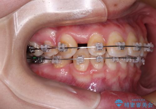 転勤でも安心して治療継続 抜歯スペース閉鎖と深い噛み合わせ改善のワイヤー矯正の治療前