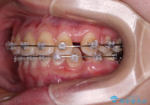 転勤でも安心して治療継続 抜歯スペース閉鎖と深い噛み合わせ改善のワイヤー矯正の治療前