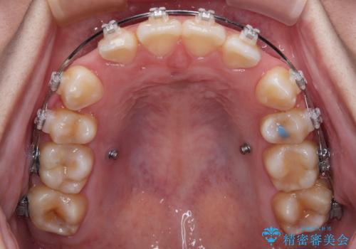 転勤でも安心して治療継続 抜歯スペース閉鎖と深い噛み合わせ改善のワイヤー矯正の治療前