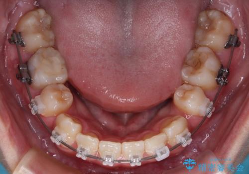 転勤でも安心して治療継続 抜歯スペース閉鎖と深い噛み合わせ改善のワイヤー矯正の治療前