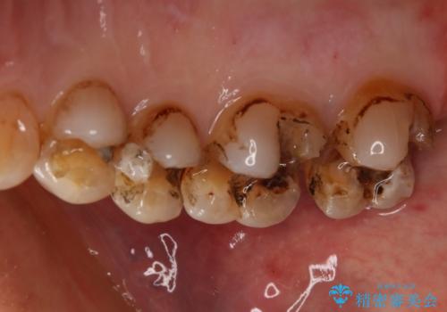 銀歯からセラミックへの治療中