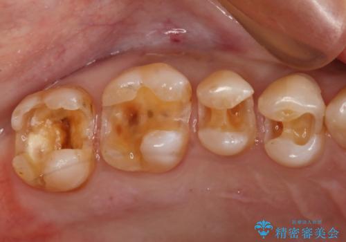 銀歯からセラミックへの治療中