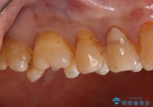 銀歯からセラミックへの治療中