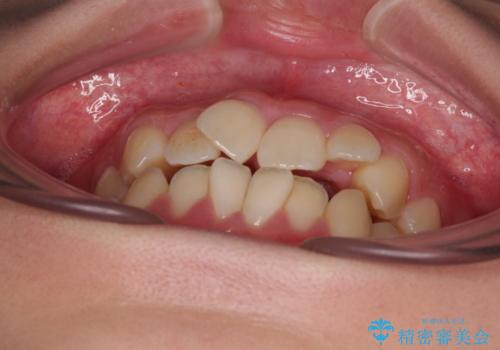 急速拡大装置 狭い骨幅を拡大した上で、口元の突出感を改善する抜歯矯正治療の治療前