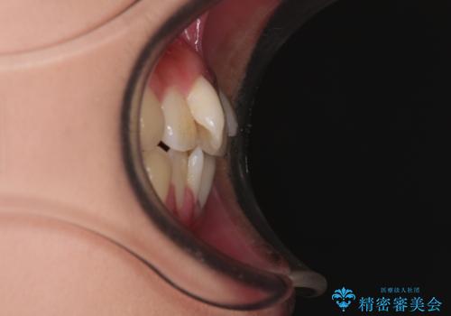 急速拡大装置 狭い骨幅を拡大した上で、口元の突出感を改善する抜歯矯正治療の治療前