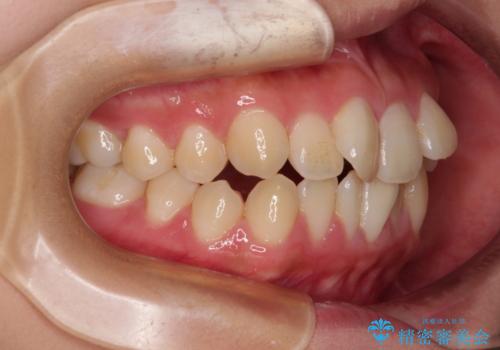 急速拡大装置 狭い骨幅を拡大した上で、口元の突出感を改善する抜歯矯正治療の治療前