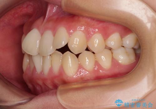 急速拡大装置 狭い骨幅を拡大した上で、口元の突出感を改善する抜歯矯正治療の治療前