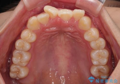 急速拡大装置 狭い骨幅を拡大した上で、口元の突出感を改善する抜歯矯正治療の治療前
