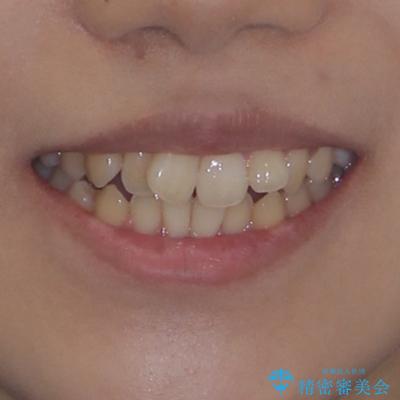 急速拡大装置 狭い骨幅を拡大した上で、口元の突出感を改善する抜歯矯正治療の治療前(顔貌)
