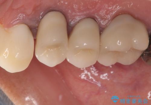 歯肉から膿が出る 破折した奥歯の抜歯即時埋入インプラントの治療前