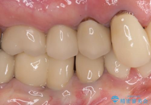 歯肉から膿が出る 破折した奥歯の抜歯即時埋入インプラントの治療前