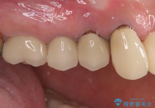 歯肉から膿が出る 破折した奥歯の抜歯即時埋入インプラントの治療前