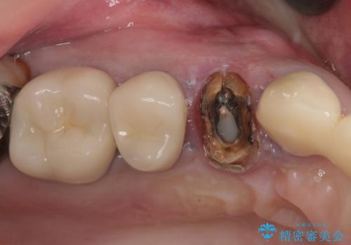 歯肉から膿が出る 破折した奥歯の抜歯即時埋入インプラントの治療前