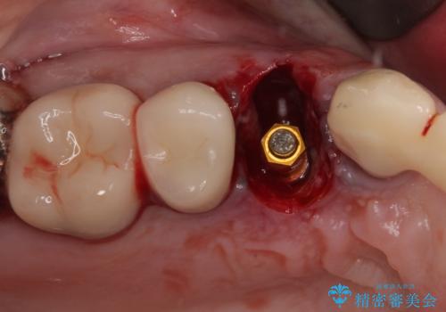 歯肉から膿が出る　破折した奥歯の抜歯即時埋入インプラントの治療前