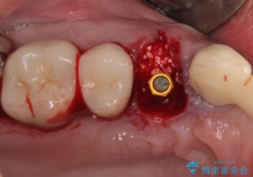 歯肉から膿が出る 破折した奥歯の抜歯即時埋入インプラントの治療中