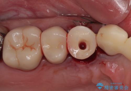 歯肉から膿が出る 破折した奥歯の抜歯即時埋入インプラントの治療中