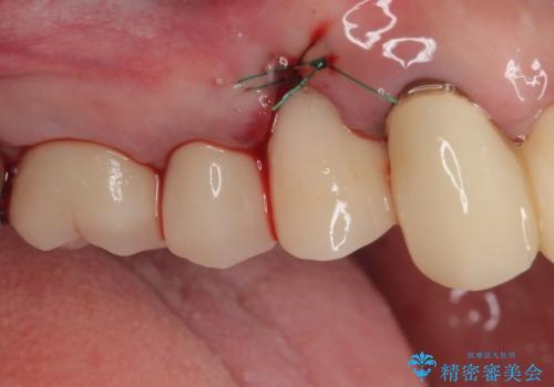 歯肉から膿が出る 破折した奥歯の抜歯即時埋入インプラントの治療中