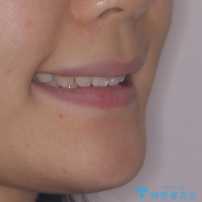 上の前歯が下唇に引っかかる 口元を引っ込めすぎない抜歯矯正治療の治療後(顔貌)