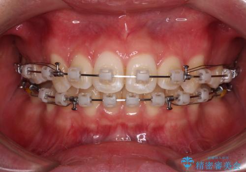 上の前歯が下唇に引っかかる 口元を引っ込めすぎない抜歯矯正治療の治療中