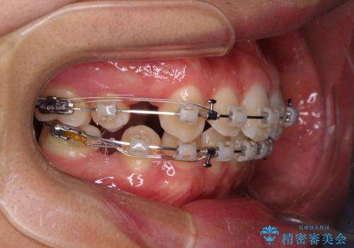 上の前歯が下唇に引っかかる 口元を引っ込めすぎない抜歯矯正治療の治療中