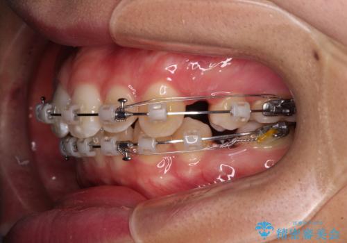 上の前歯が下唇に引っかかる 口元を引っ込めすぎない抜歯矯正治療の治療中