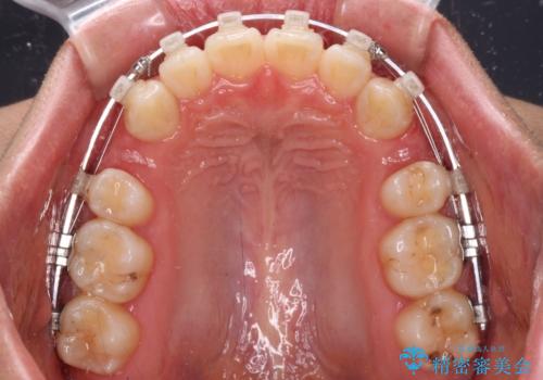 上の前歯が下唇に引っかかる 口元を引っ込めすぎない抜歯矯正治療の治療中