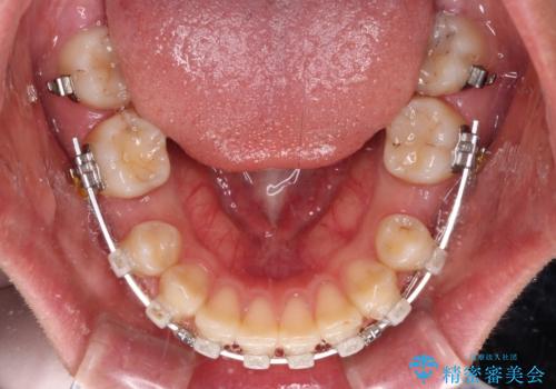 上の前歯が下唇に引っかかる 口元を引っ込めすぎない抜歯矯正治療の治療中