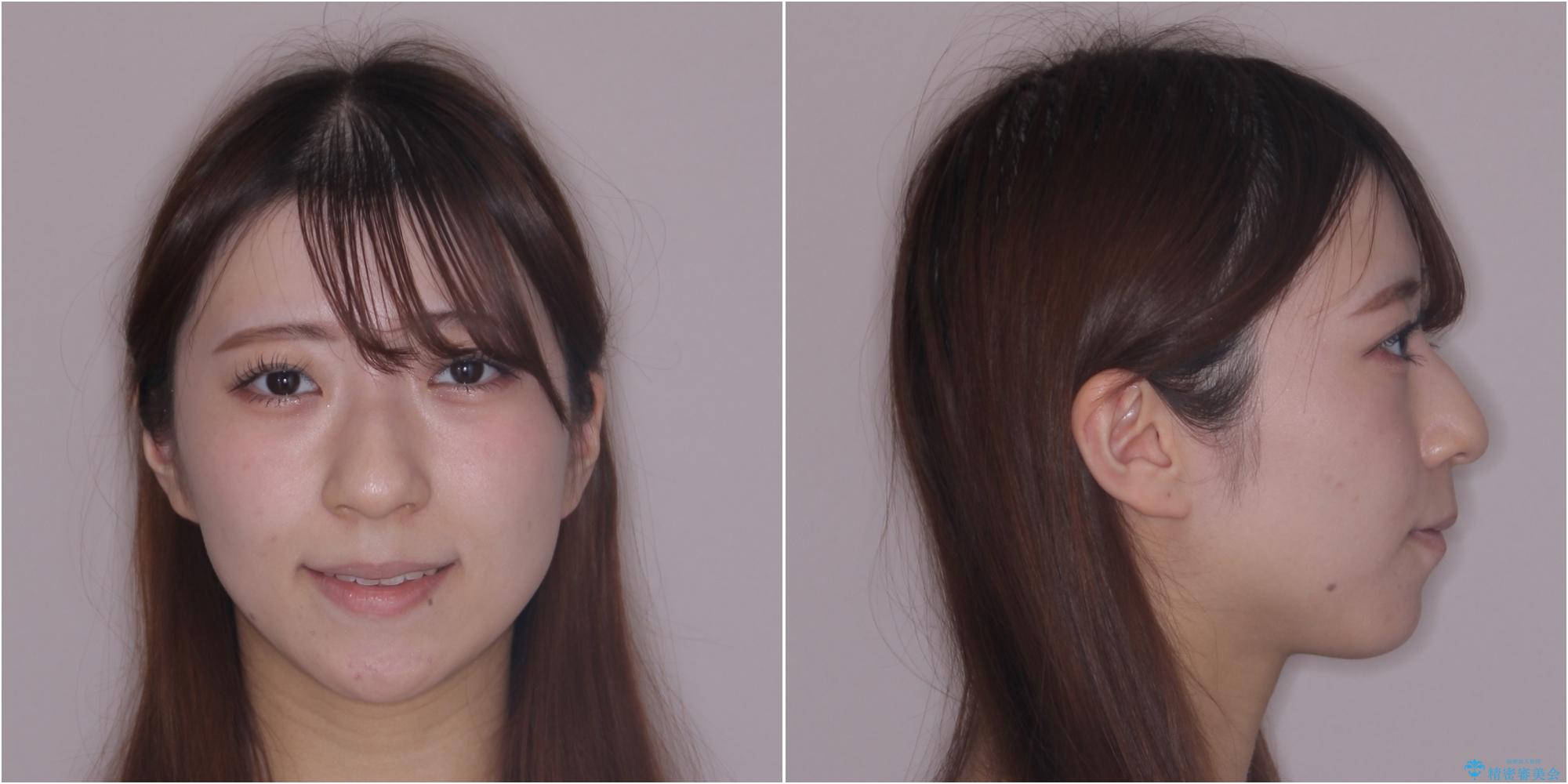 【モニター】とがった口元を抜歯して改善 ワイヤー装置の矯正治療の治療後(顔貌)