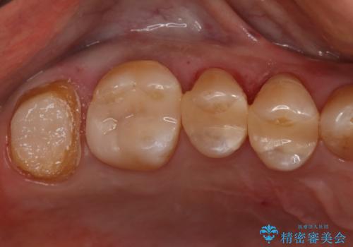 銀歯からセラミックへの治療中