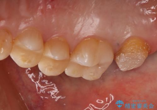 銀歯からセラミックへの治療中