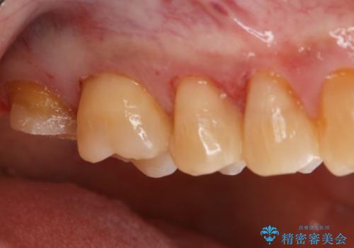 銀歯からセラミックへの治療中