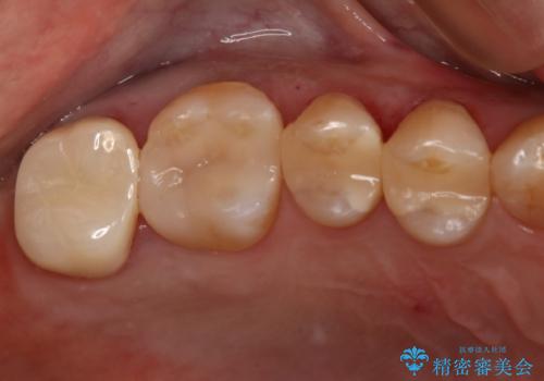 銀歯からセラミックへの治療後