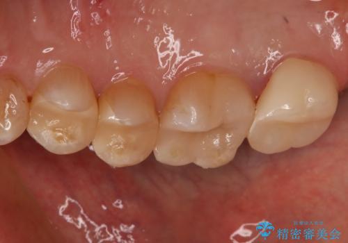 銀歯からセラミックへの治療後